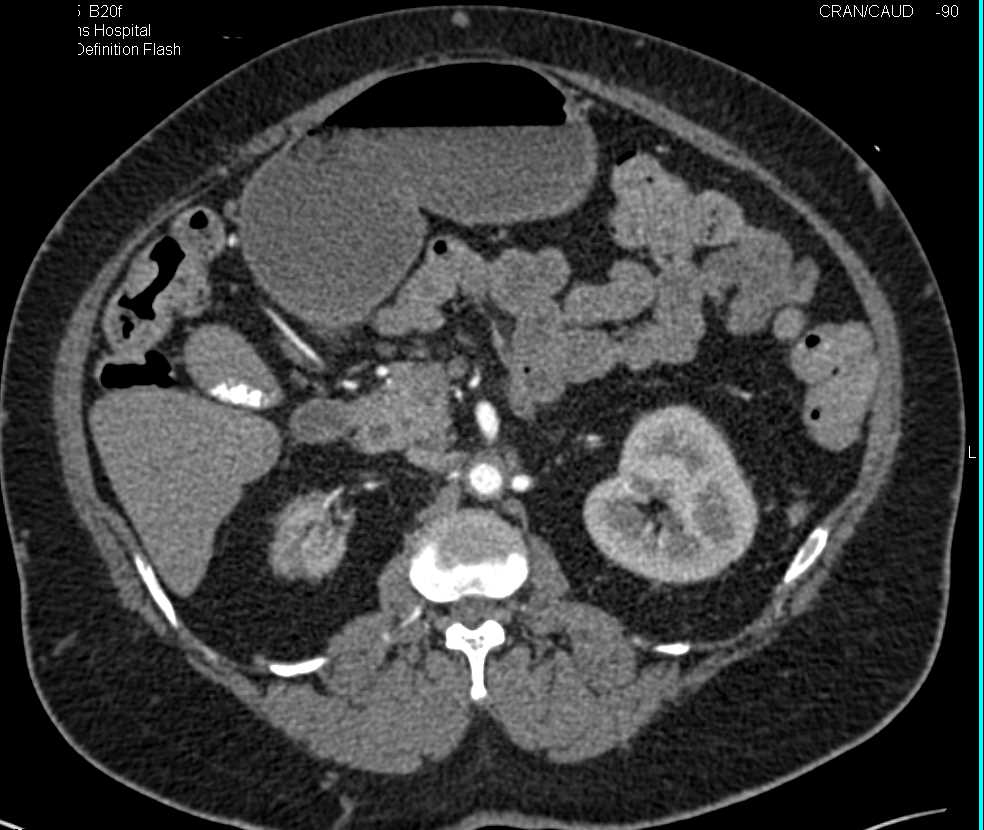 Retroperitoneal Fibrosis Encases the Aorta - CTisus CT Scan