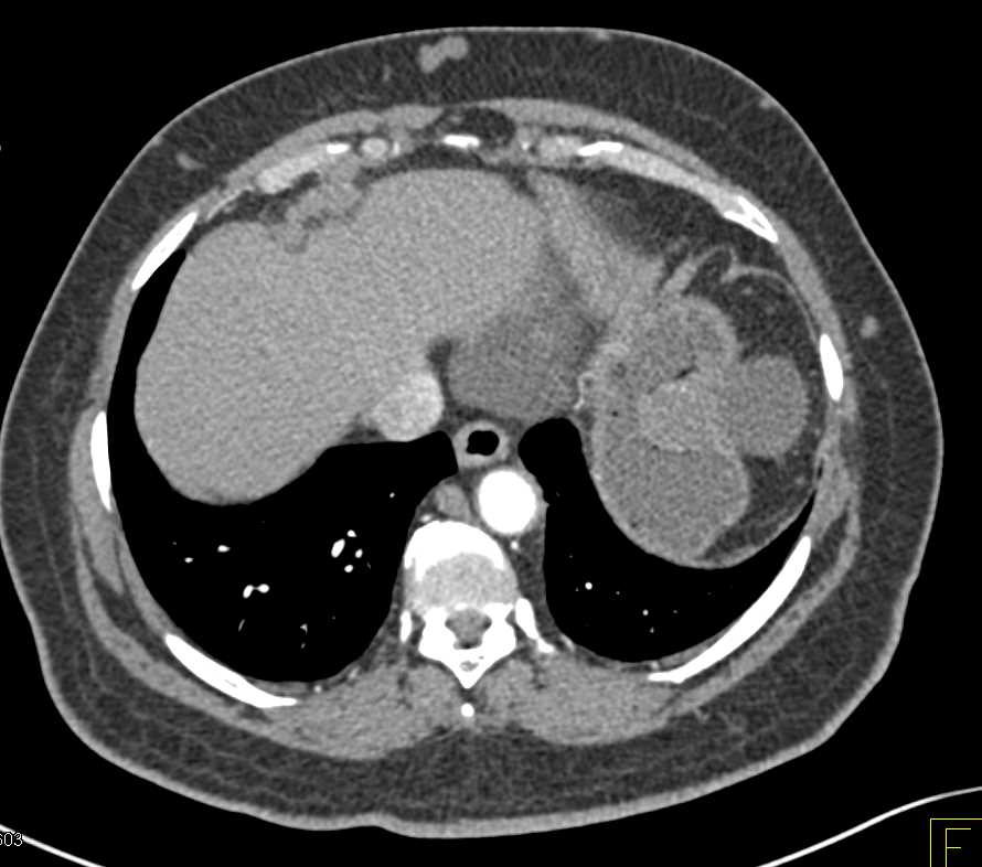 Retroperitoneal Fibrosis Encases the Aorta - CTisus CT Scan