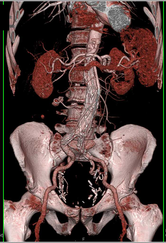 Normal Endovascular Stent Study - CTisus CT Scan