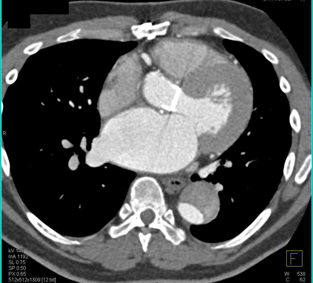 Type A Dissection with Compressed True Lumen - CTisus CT Scan