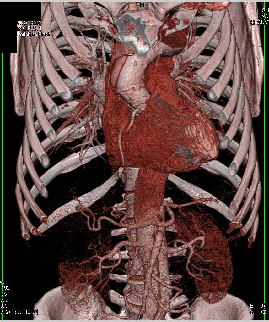 Nice 3D Display of Type A Dissection with Compromised True Lumen in Thoracic Aorta - CTisus CT Scan