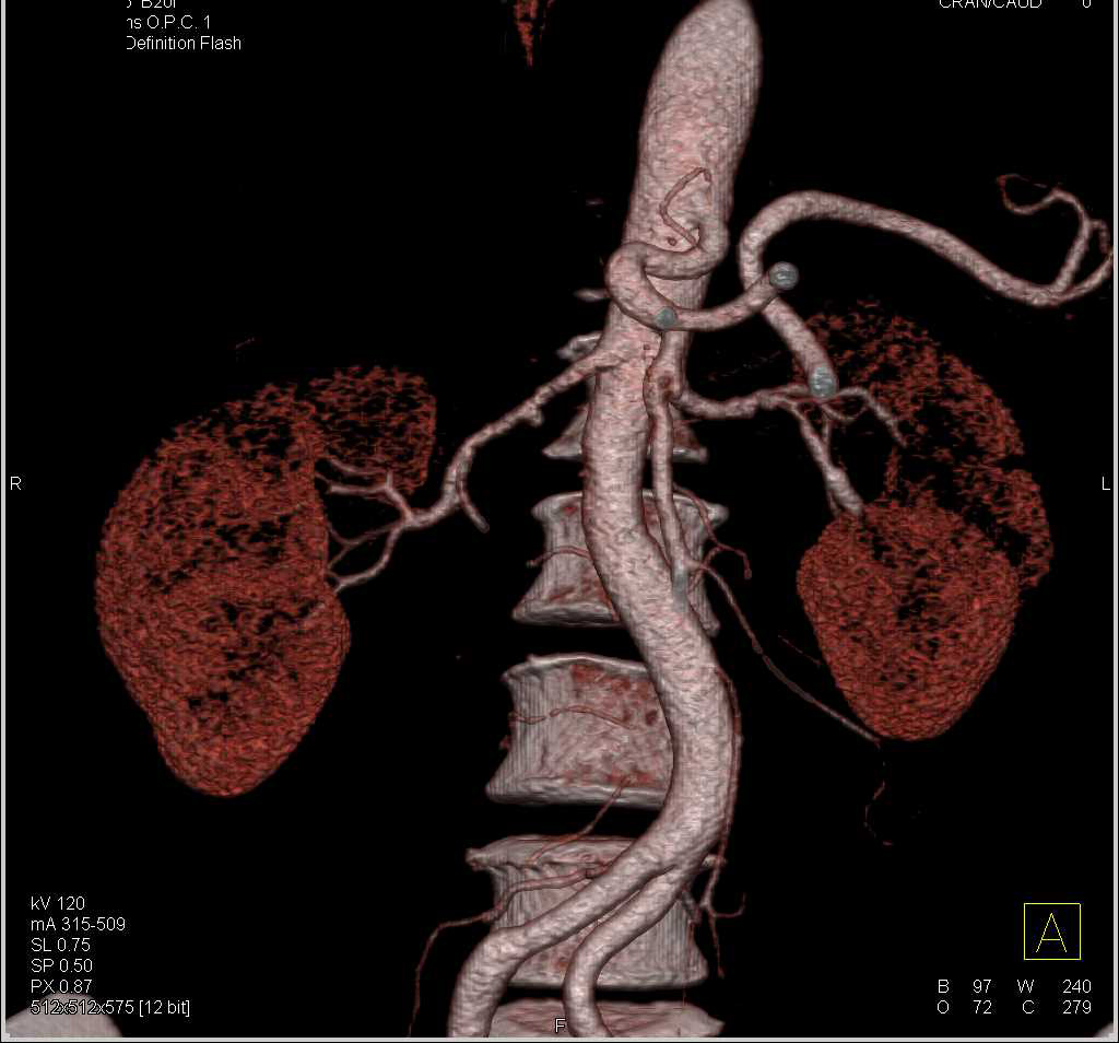 Fibromuscular Dysplasia of the Renal Arteries (FMD) - CTisus CT Scan