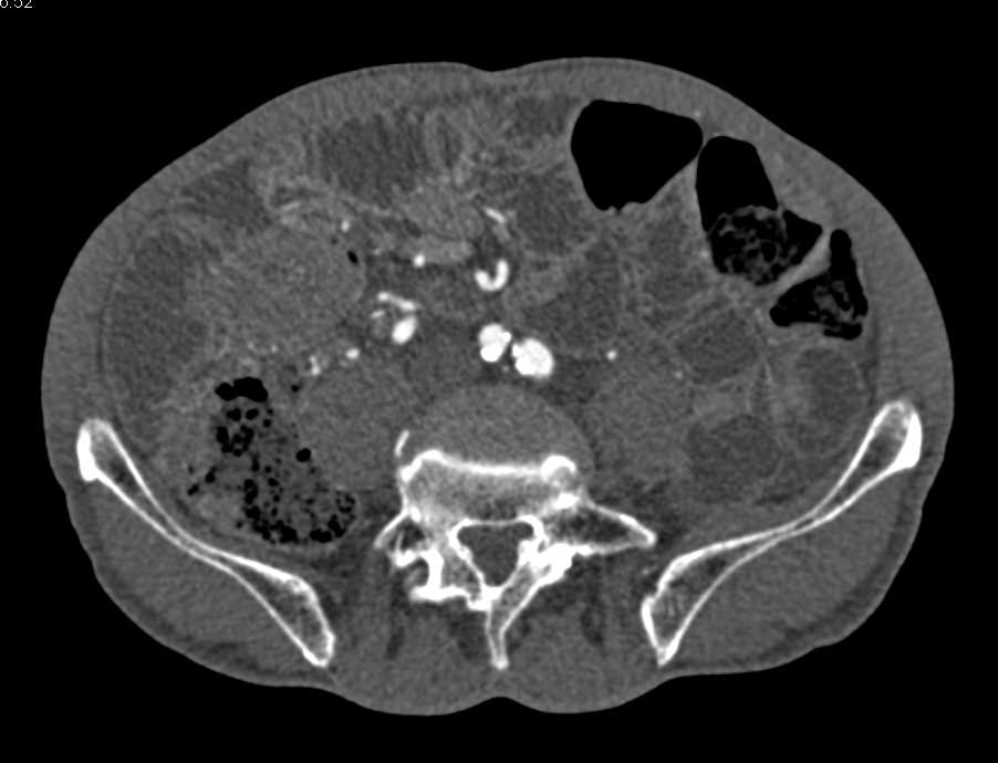 CTA Evaluation of the Abdominal Aorta with Dual Energy and Bone Removal - CTisus CT Scan