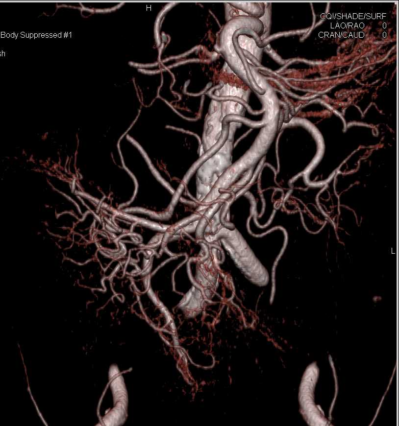 CTA Evaluation of the Abdominal Aorta with Dual Energy and Bone Removal - CTisus CT Scan