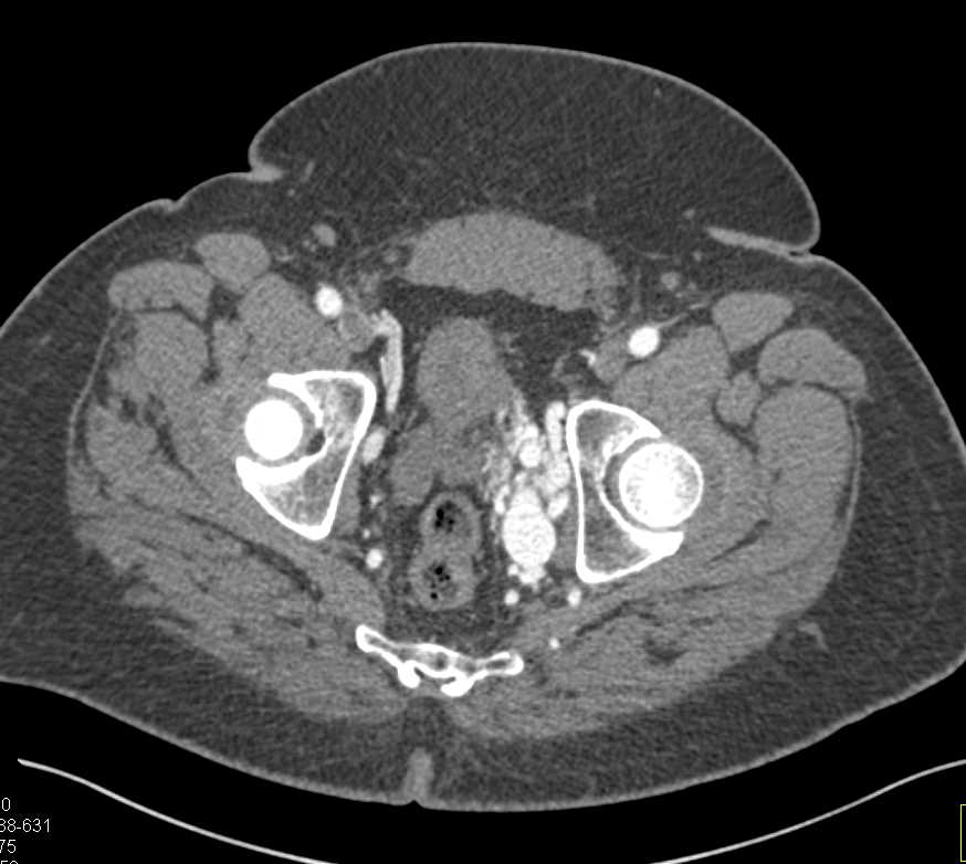Vascular Malformation Left Pelvic Sidewall - CTisus CT Scan