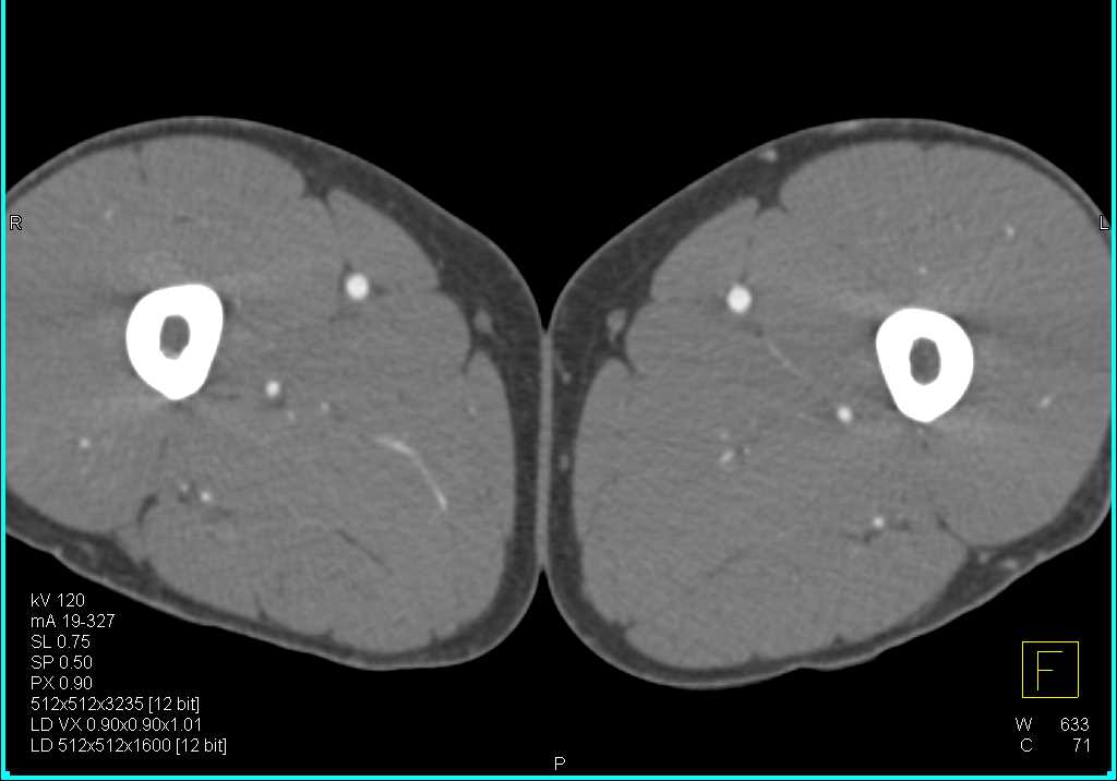 CTA Runoff with Clot in Right Poplteal Artery - CTisus CT Scan