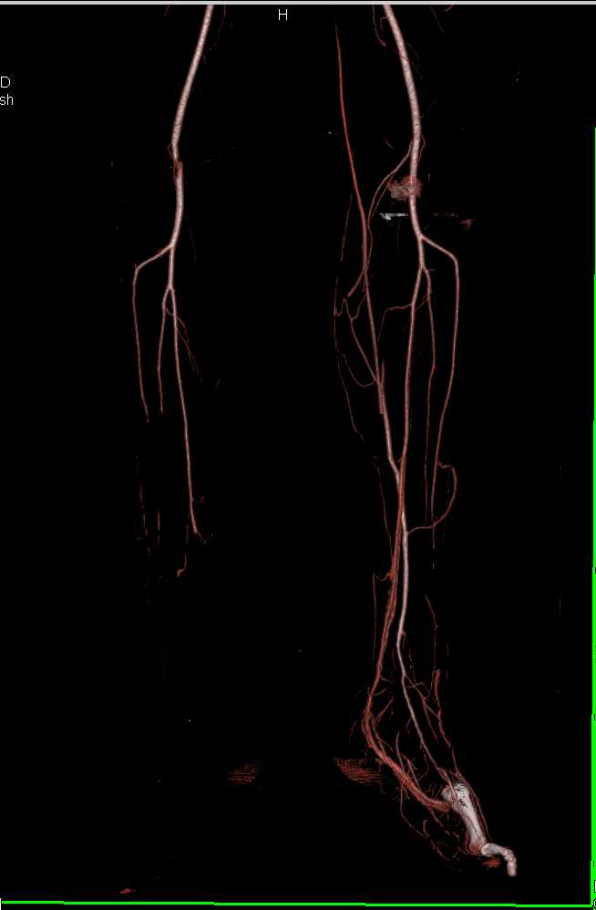 CTA Runoff with Clot in Right Poplteal Artery - CTisus CT Scan