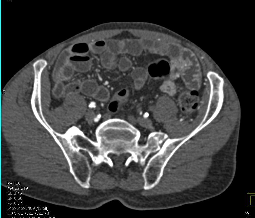 Aortic Aneurysm with Occluded Left Common Iliac Artery - CTisus CT Scan