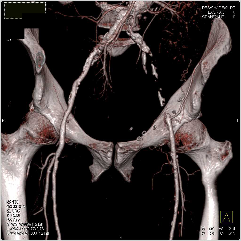 Aortic Aneurysm with Occluded Left Common Iliac Artery - Vascular Case ...