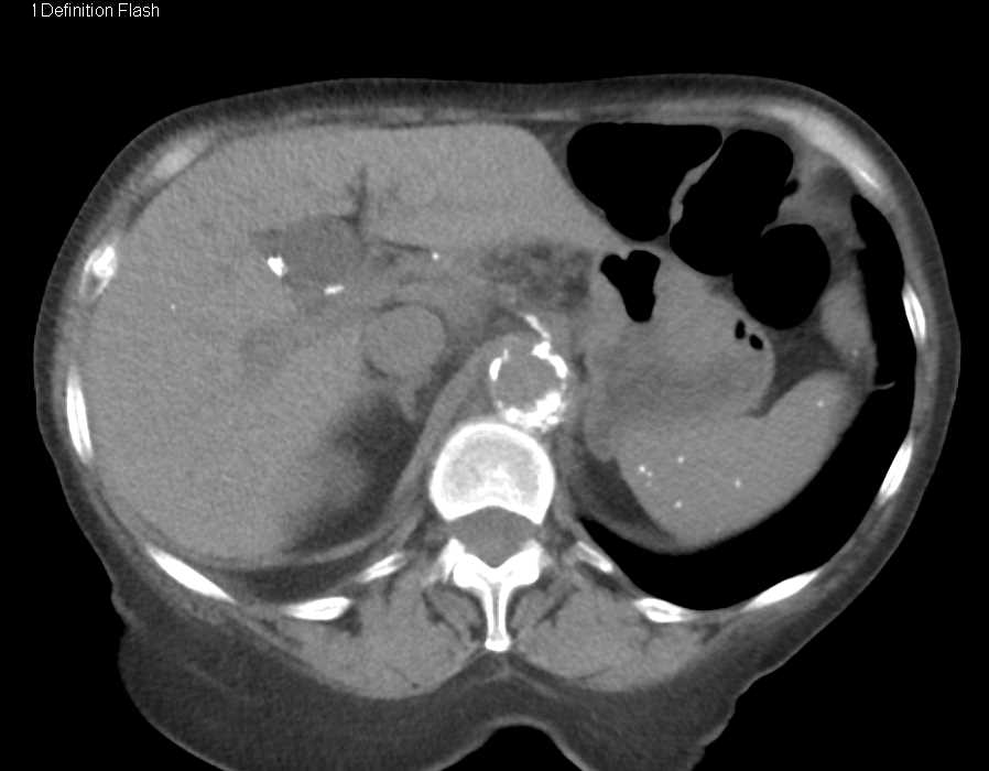 Perianeurysmal Fibrosis Around the Aorta - CTisus CT Scan