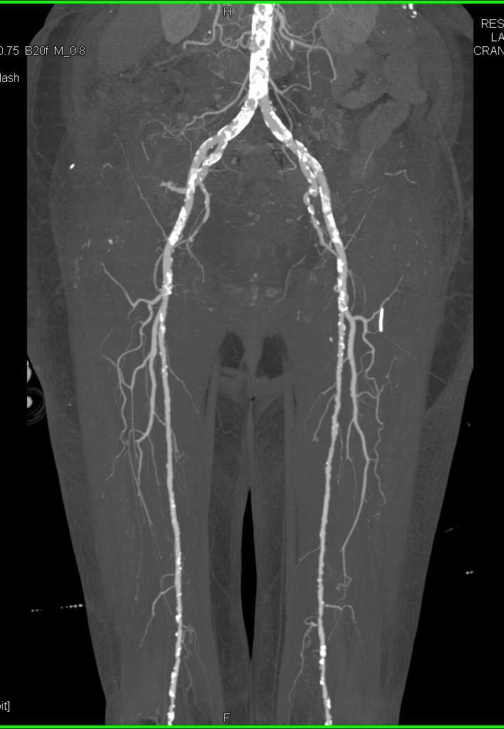 CTA Runoff with Peripheral Vascular Disease - CTisus CT Scan