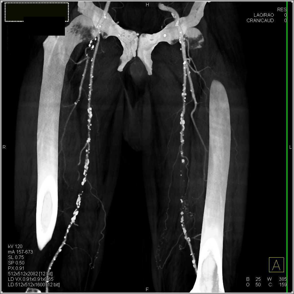 CTA Runoff with Peripheral Vascular Disease and Bilateral Superficial Femoral Artery (SFA) Occlusions - CTisus CT Scan
