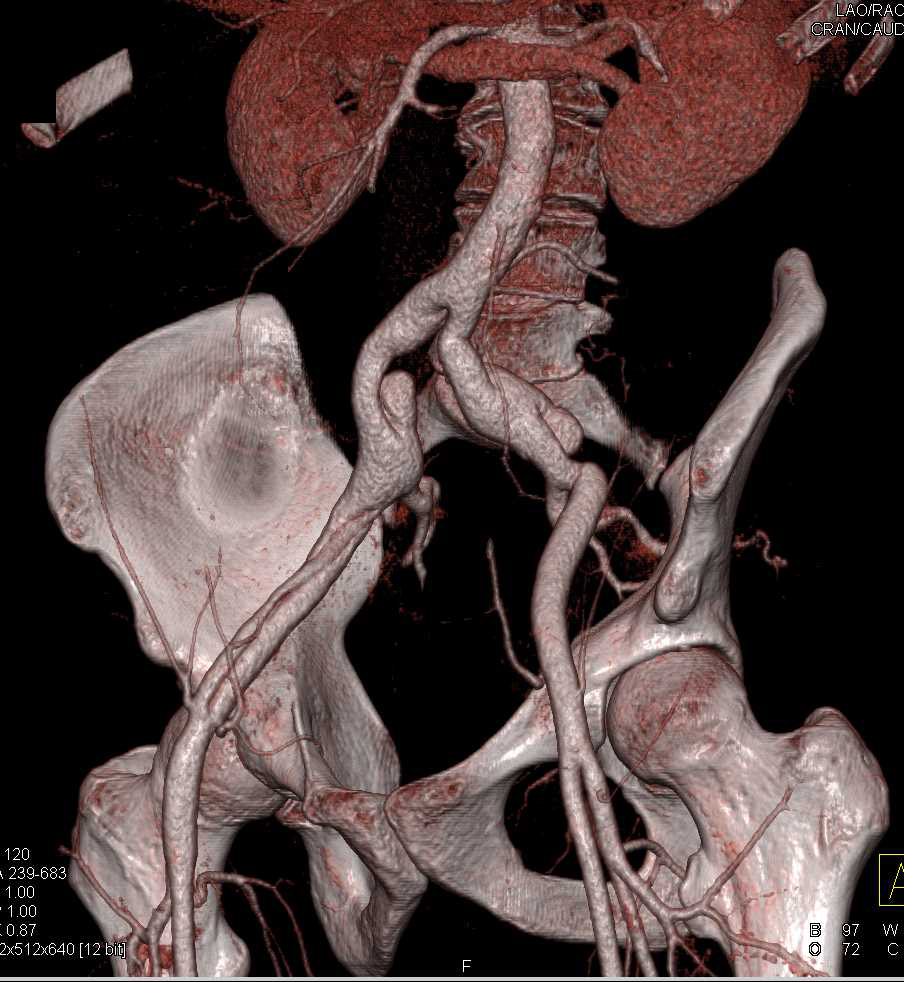 Dissection Right Common and External Iliac Arteries - CTisus CT Scan