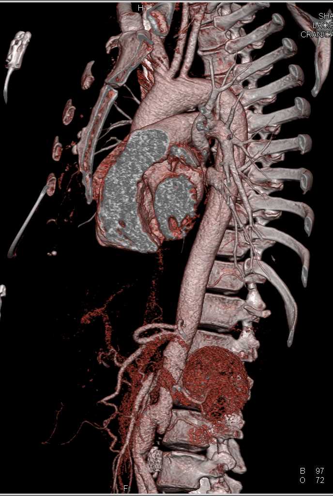 Occlusion of the Abdominal Aorta with Bypass Grafts - CTisus CT Scan