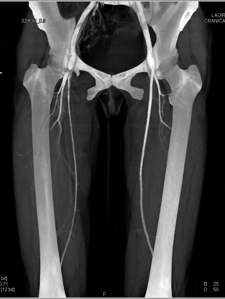 Critical Stenosis of the Right Superficial Femoral Artery (SFA) with