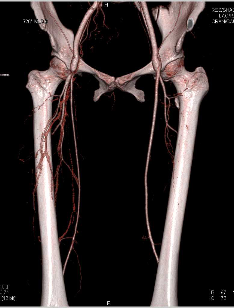 Critical Stenosis of the Right Superficial Femoral Artery (SFA) with