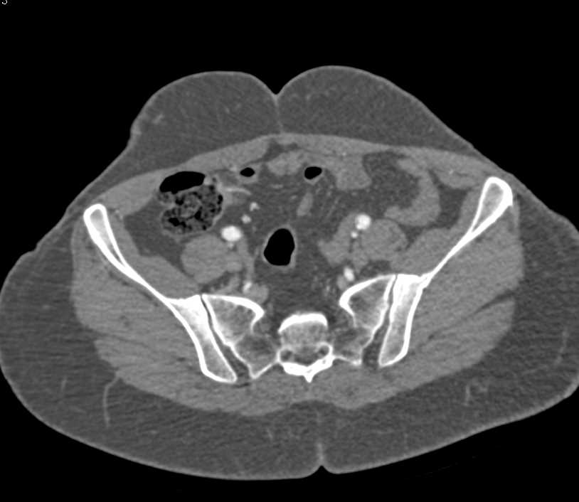 Critical Stenosis of the Right Superficial Femoral Artery (SFA) with CTA - CTisus CT Scan
