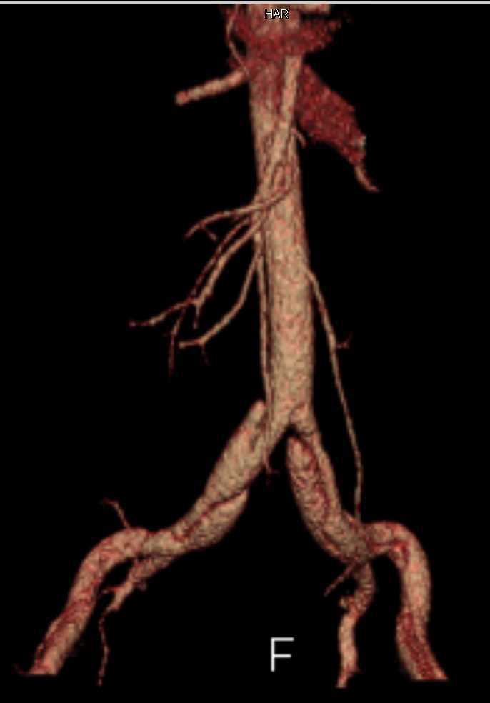 Aortic Dissection Involves the Abdominal Aorta and Iliac Arteries - CTisus CT Scan