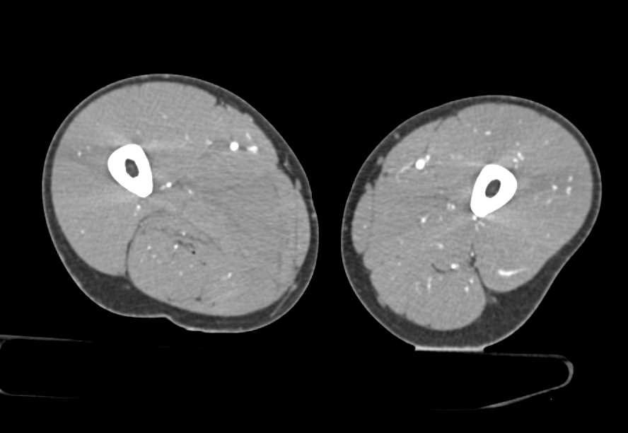 Superficial Femoral Artery (SFA) Occlusion in Patient with Tibia/Fibula Fracture - CTisus CT Scan