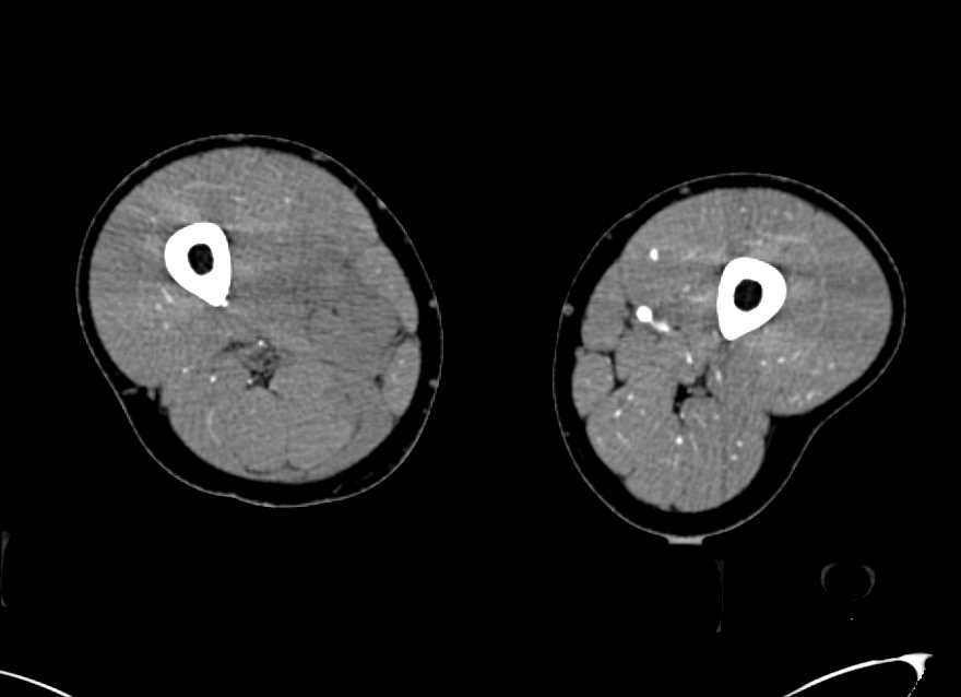 Superficial Femoral Artery (SFA) Occlusion in Patient with Tibia/Fibula Fracture - CTisus CT Scan