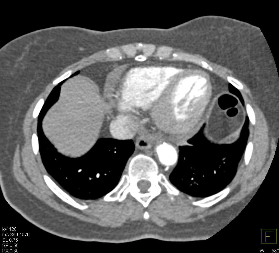 Intramural Hematoma the Ascending Aorta - CTisus CT Scan