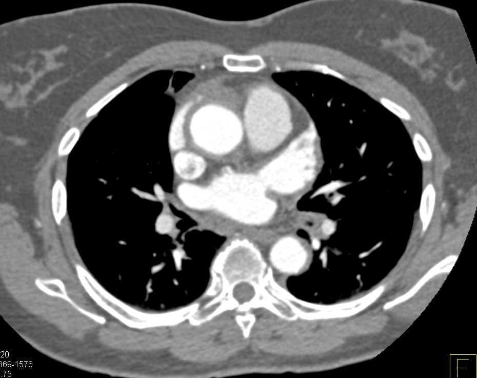 Intramural Hematoma the Ascending Aorta - CTisus CT Scan