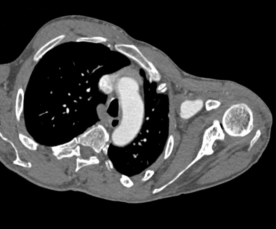 CTA with Clot in the Left Brachial Artery Seen Nicely on 3D Images - CTisus CT Scan