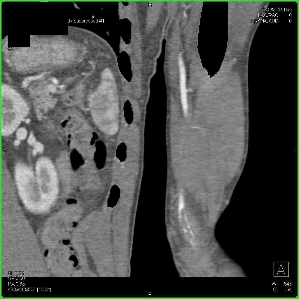 CTA with Clot in the Left Brachial Artery Seen Nicely on 3D Images - CTisus CT Scan