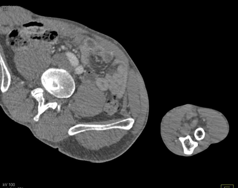 Aneurysmal Dilatation of the Axillary Artery with Focal Dissection - CTisus CT Scan