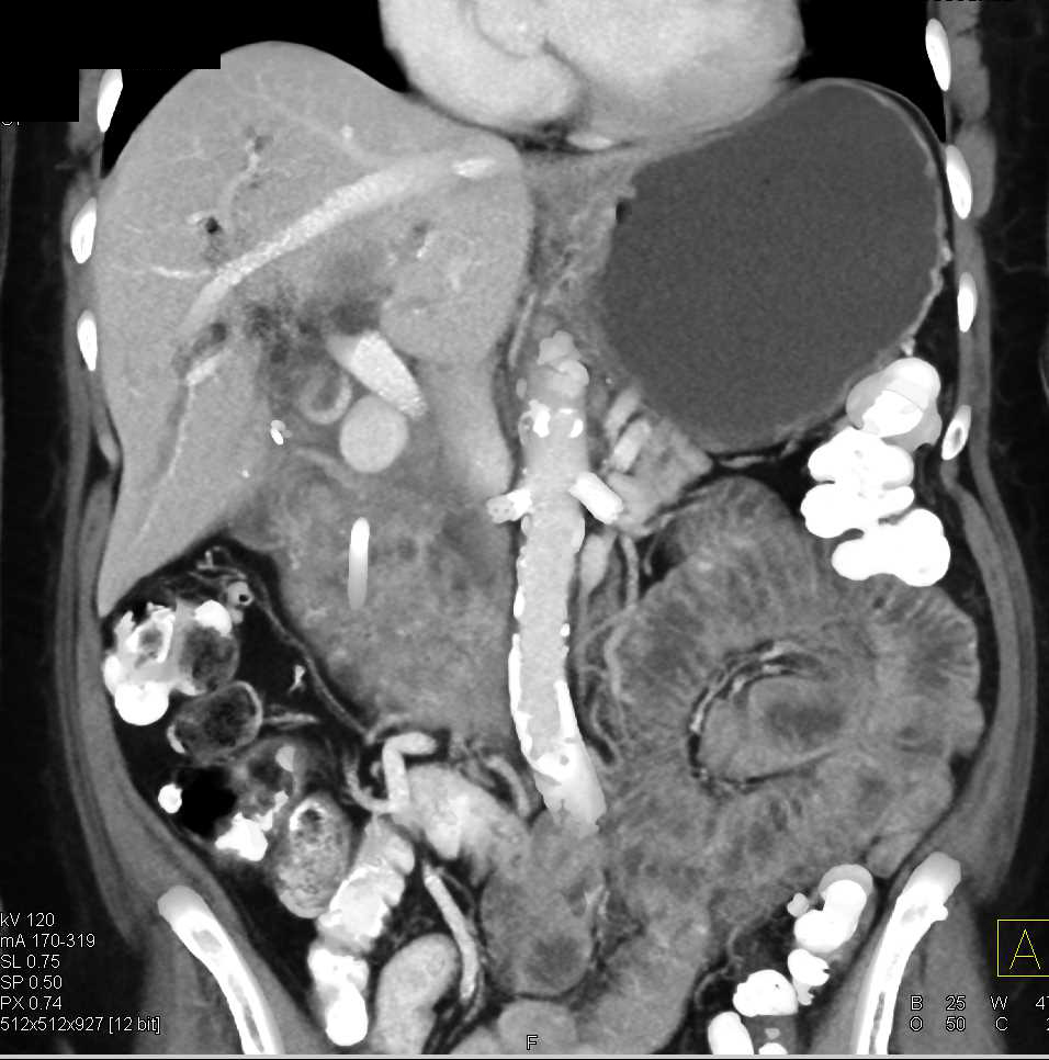 Gastroduodenal Artery (GDA) Pseudoaneurysm with Active Extravasation - CTisus CT Scan