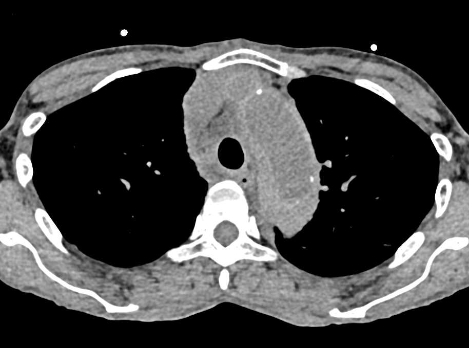 Beautiful Intramural Hematoma Seen on Non-Contrast CT Scans - CTisus CT Scan