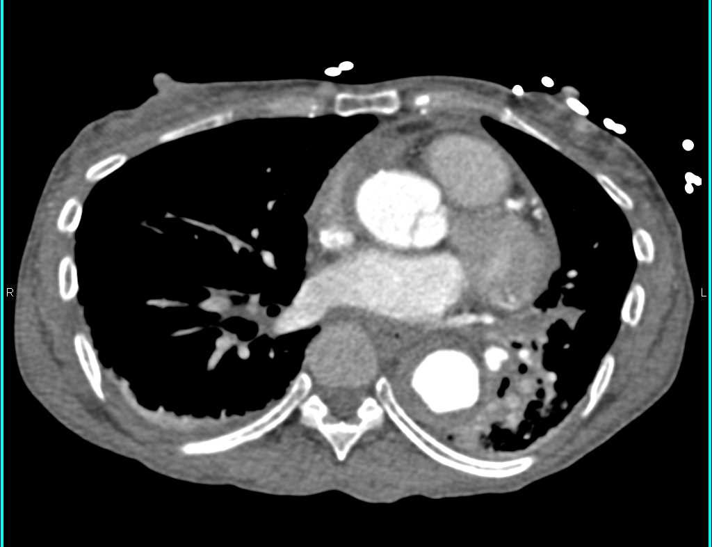 Intramural hematoma with Focal Ulcerations Descending Thoracic Aorta - CTisus CT Scan