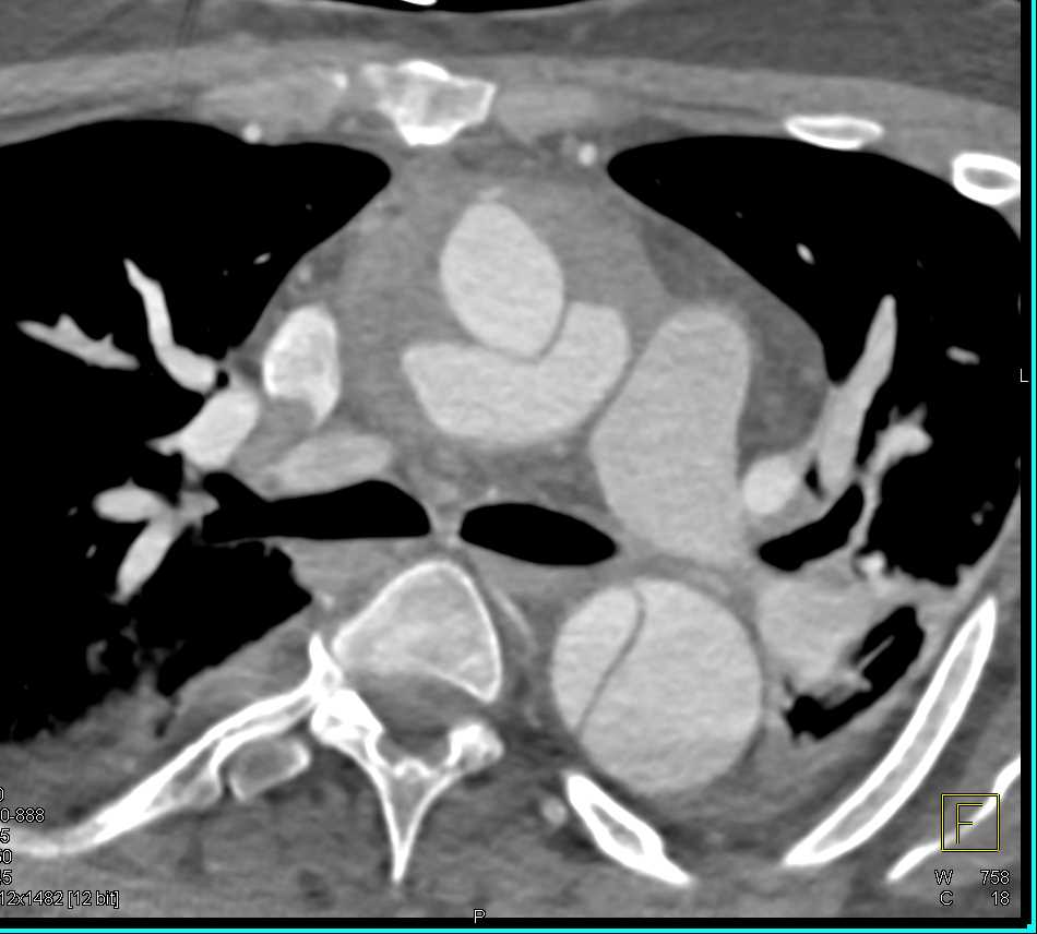 Type A Dissection - CTisus CT Scan