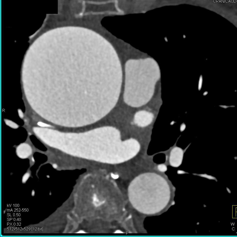 Dilated Ascending Aorta Without Dissection - CTisus CT Scan