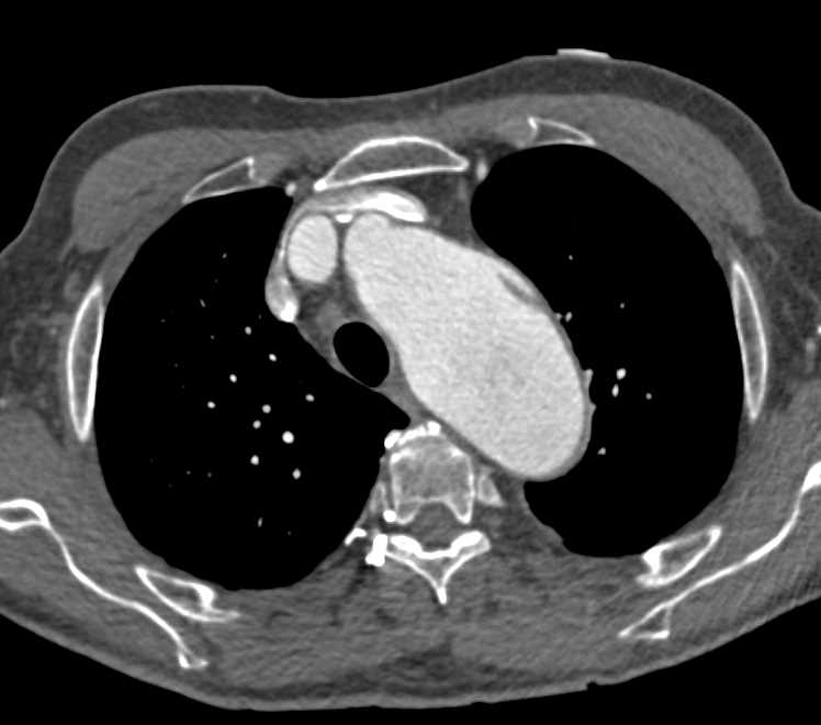 Dilated Root with Dissection in Roof - CTisus CT Scan