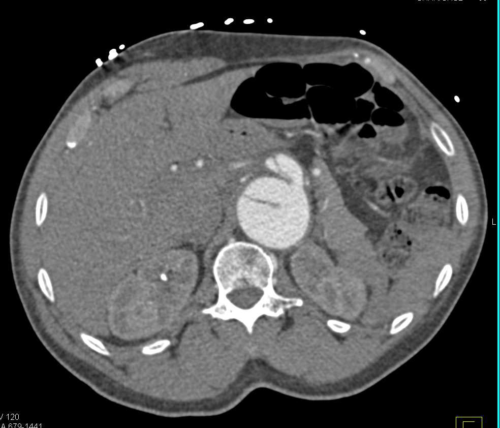 Aortic Dissection Involves the Superior Mesenteric Artery (SMA) and Celiac Artery - CTisus CT Scan