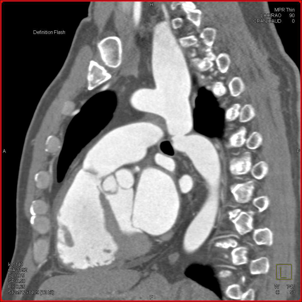 Coarctation of the Aorta with Dilated Left Subclavian Artery - CTisus CT Scan