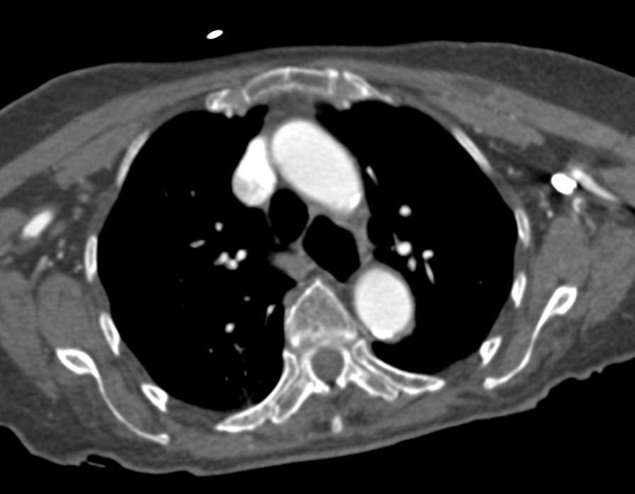 CTA Visualization of the Right Subclavian Artery in 3D - CTisus CT Scan