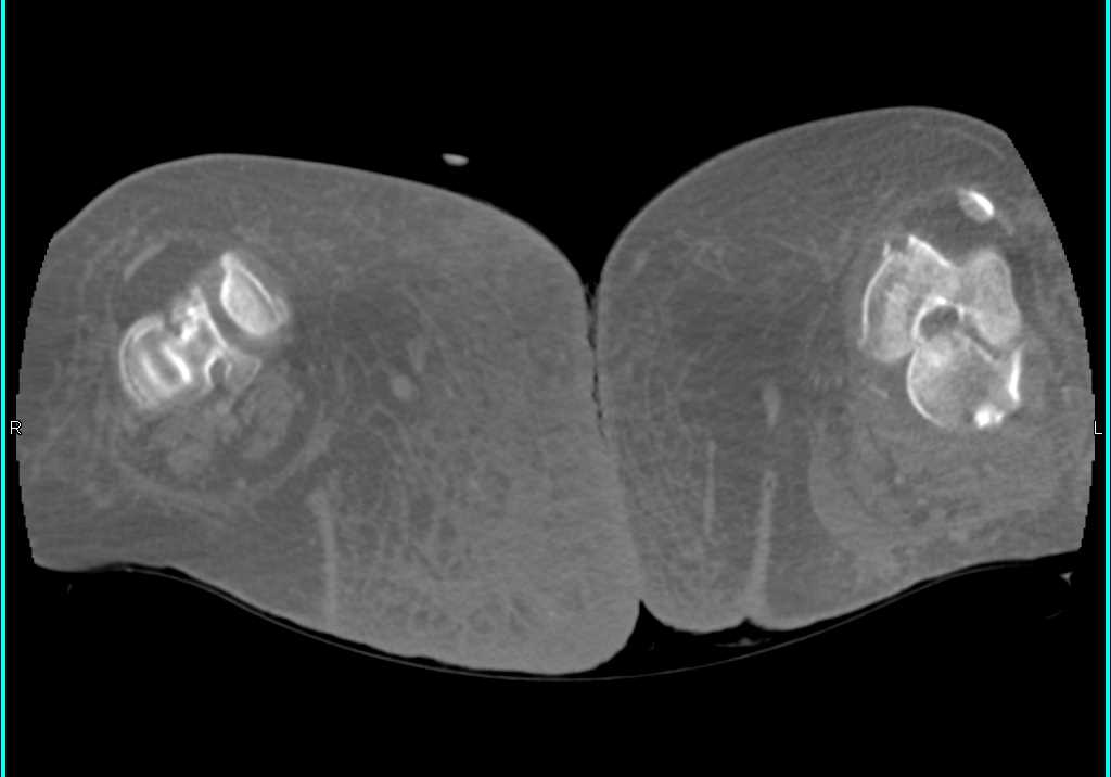 CTA of Lower Extremities in Patient with Cellulitis - CTisus CT Scan