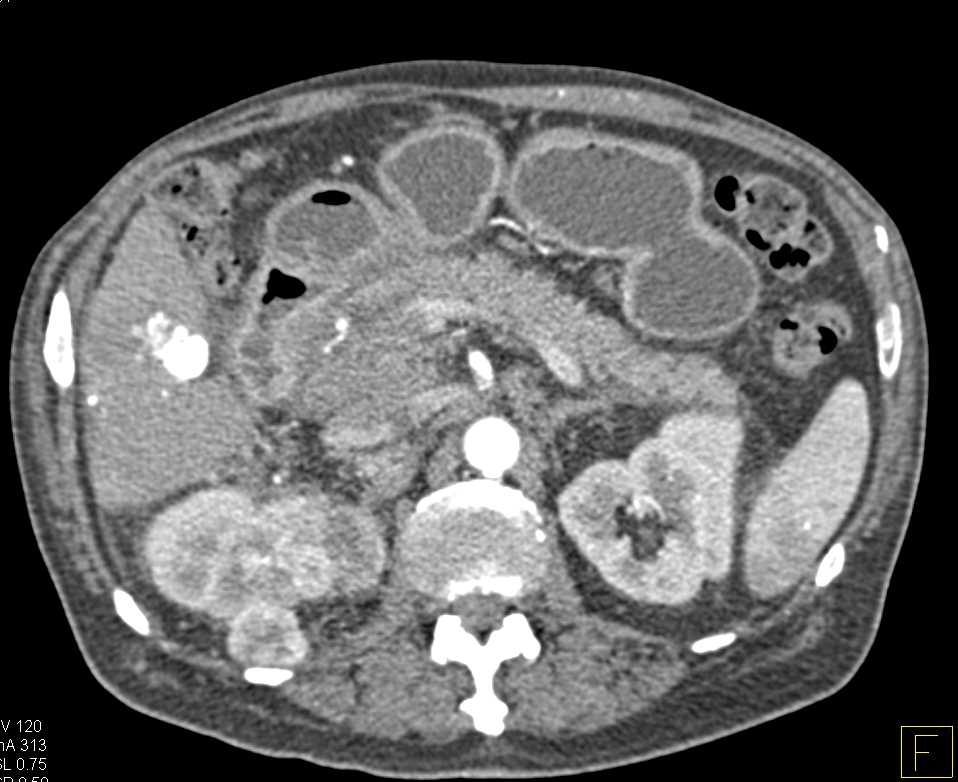 Gastroduodenal Artery (GDA) Pseudoaneurysm and Incidental Right Renal Cell Carcinoma - CTisus CT Scan