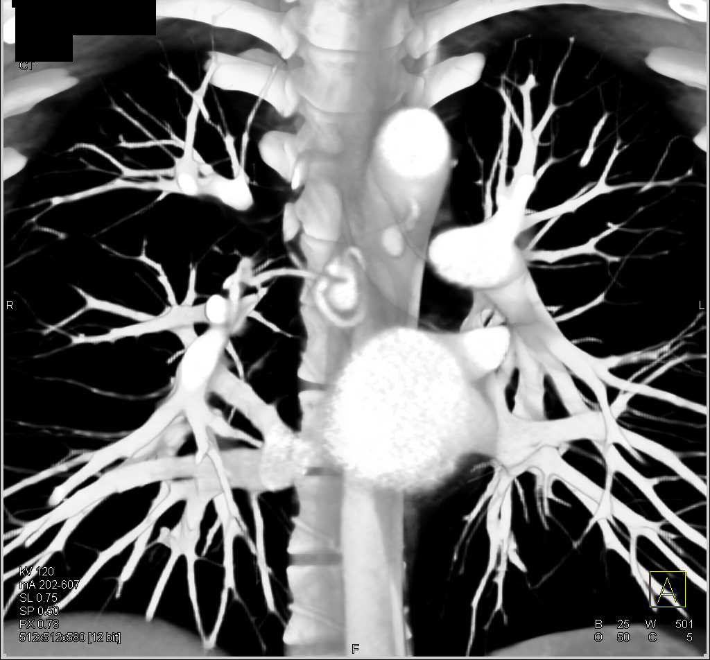 Aneurysm of the Bronchial Artery - CTisus CT Scan