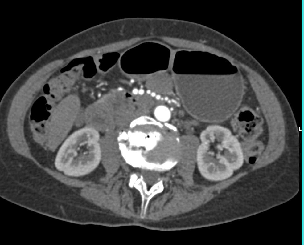 Vasculitis Involving Superior Mesenteric Artery (SMA) Branches - CTisus CT Scan