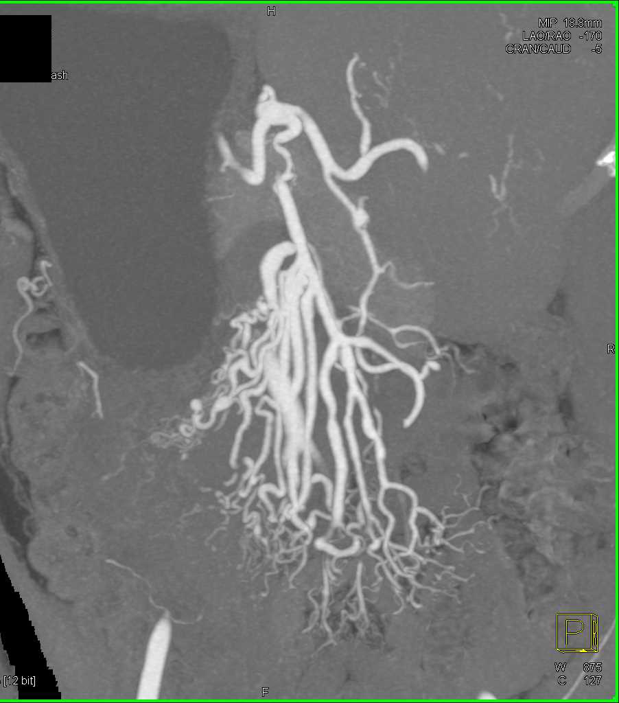 Vasculitis Involving Superior Mesenteric Artery (SMA) Branches - CTisus CT Scan