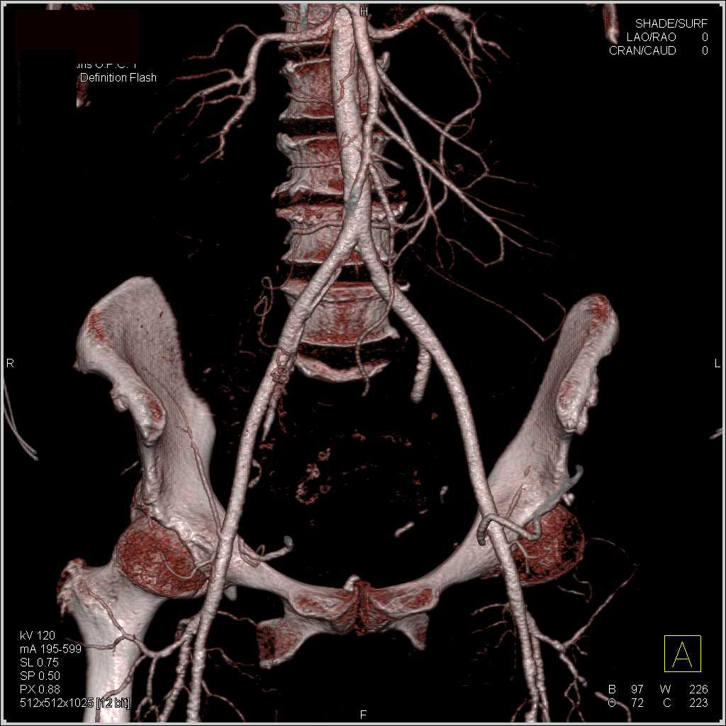 Normal External Iliac Arteries - CTisus CT Scan
