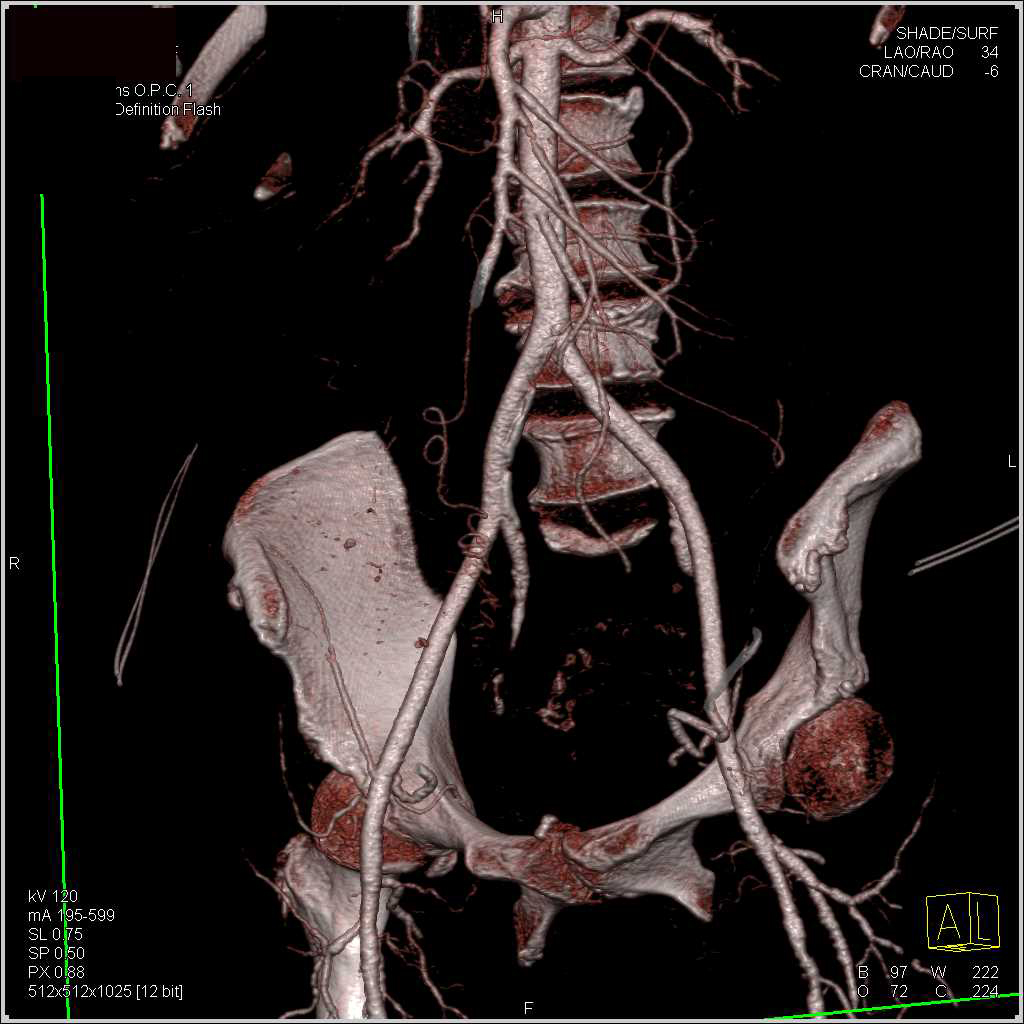 Normal External Iliac Arteries - Vascular Case Studies - CTisus CT Scanning