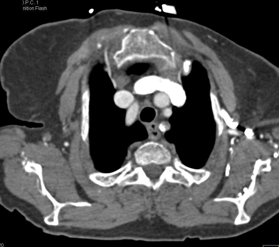 Near Occlusion of the Left Subclavian Artery by Calcified Plaque - CTisus CT Scan