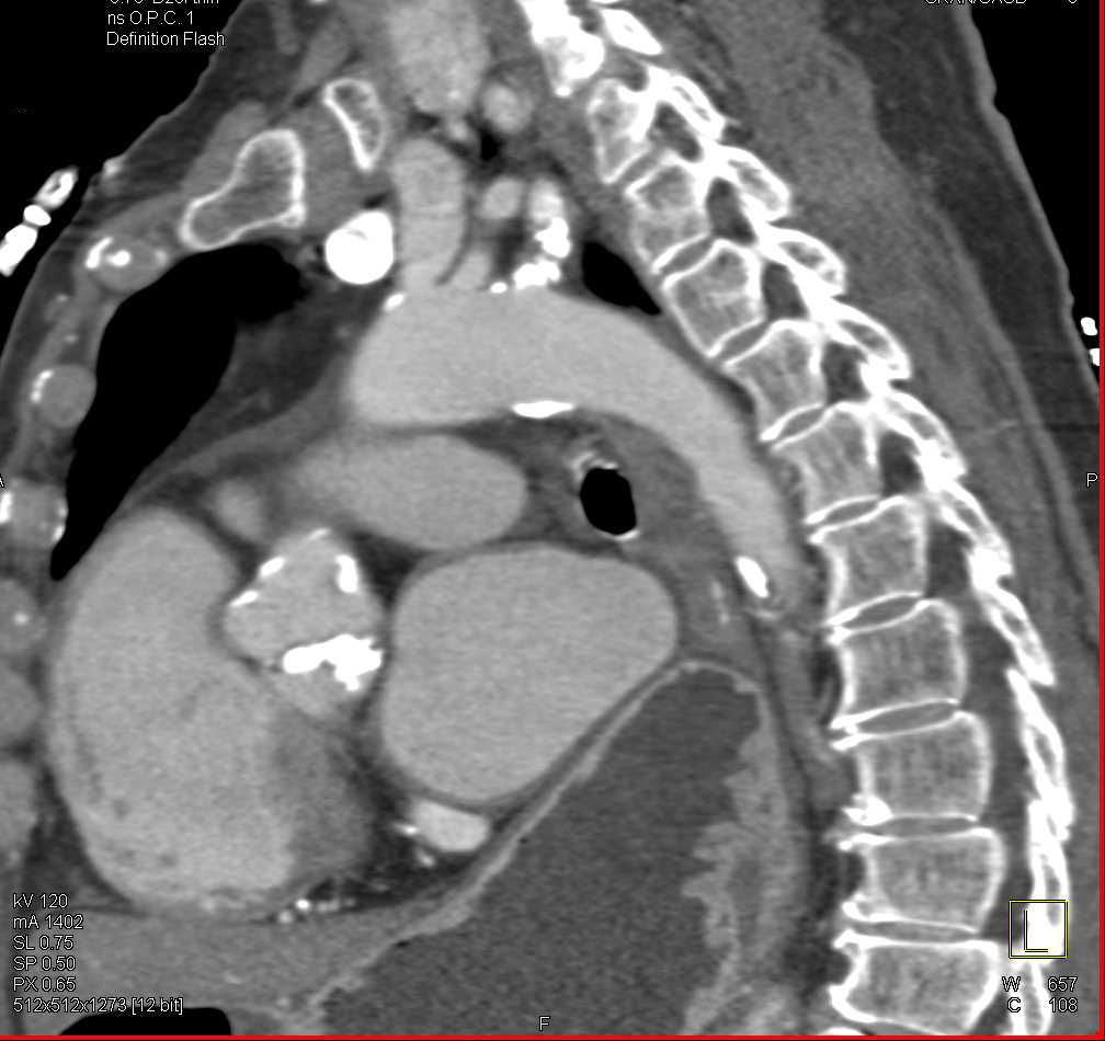 Stenosis Left Subclavian Artery - CTisus CT Scan