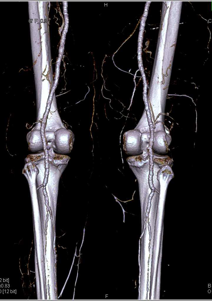 DE CTA Runoff with Minimal Vascular Disease - CTisus CT Scan