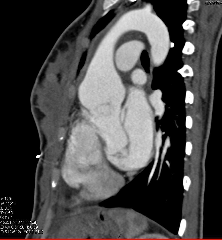 Marfan Syndrome with Dilated Aortic Root and Skeletal Changes - CTisus CT Scan