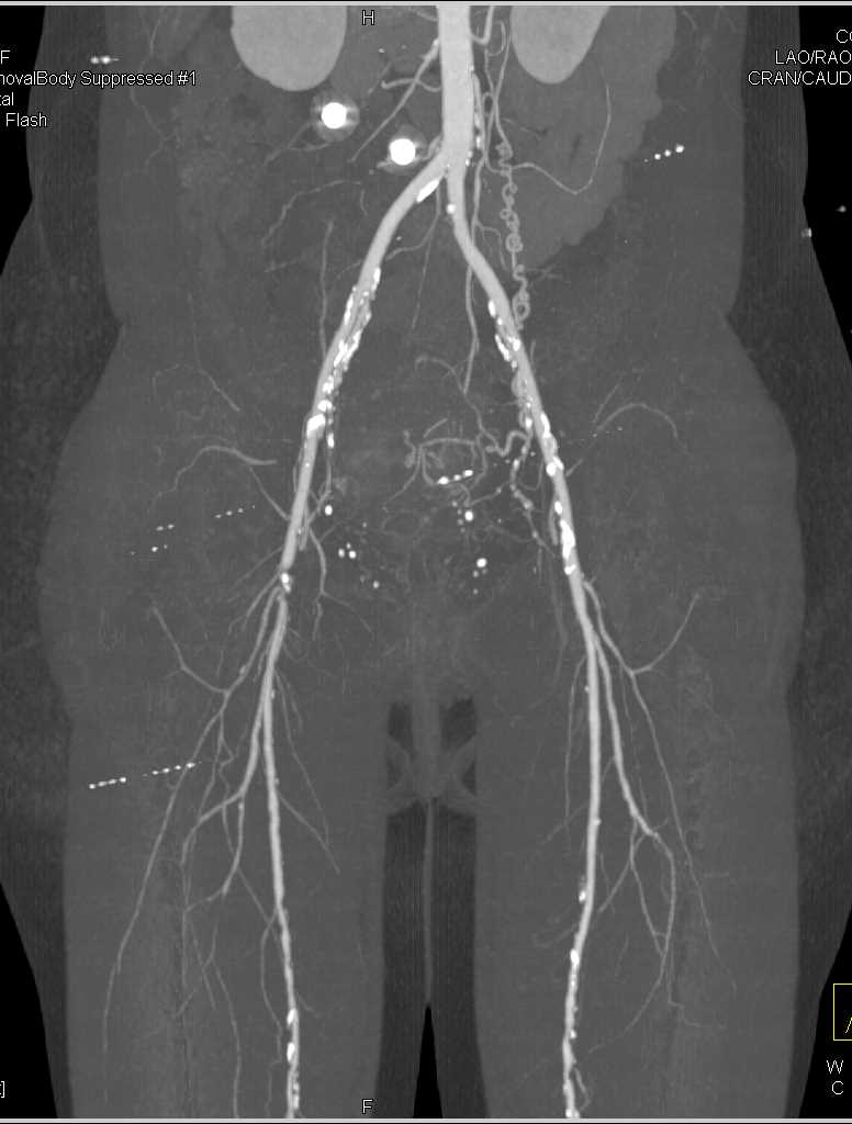 CTA Runoff with Peripheral Vascular Disease - CTisus CT Scan